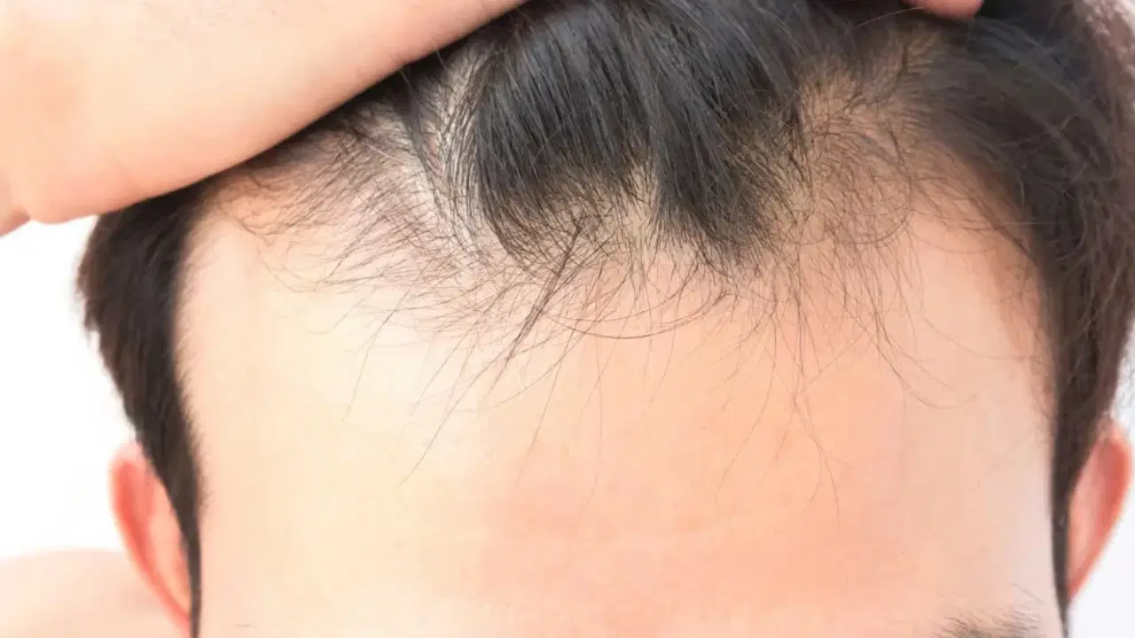 sac dokulmesinde gizli neden vitamin ve mineral eksikligi ne kadar etkili fskBIler.jpg